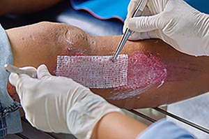 Wound care